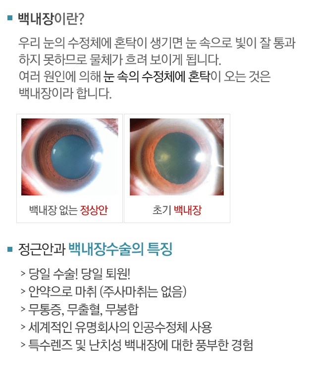 백내장사진